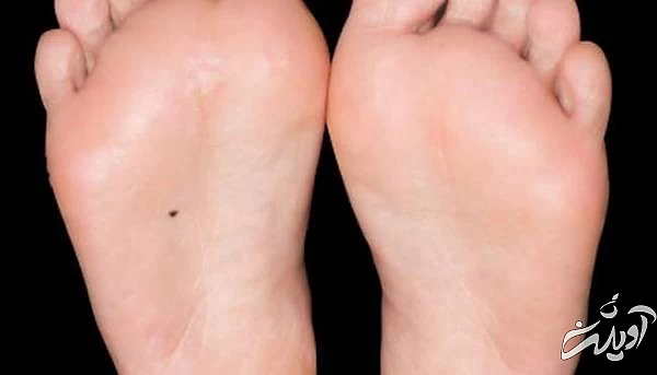 خال در پاها